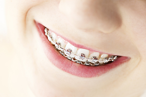 Braces in Noe Valley