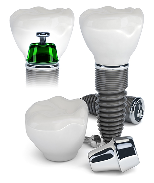 Dental Implants near Noe Valley