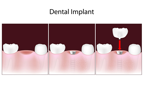 Mission District Dental Implants