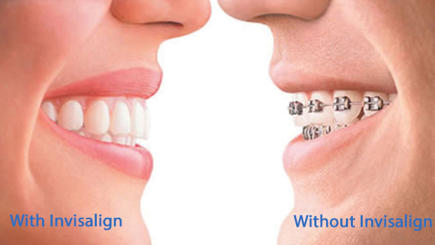 Mission District Invisalign