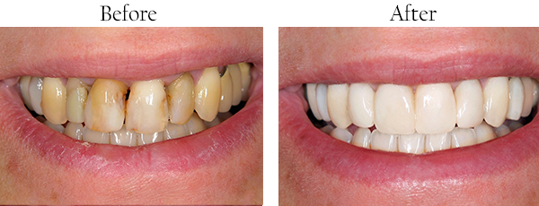 Noe Valley Before and After Teeth Whitening