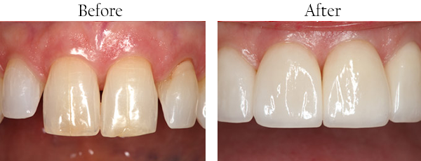 Mission District Before and After Dental Implants